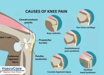 CAUSES-OF-KNEE-PAIN