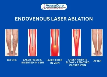 Choose Varicose Vein Laser Treatment