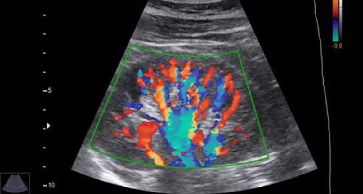 Colour Doppler Sonography