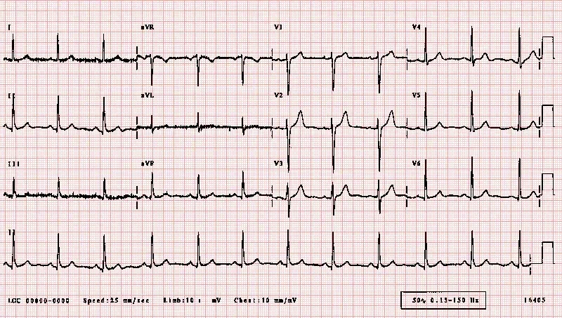 ECG Testing
