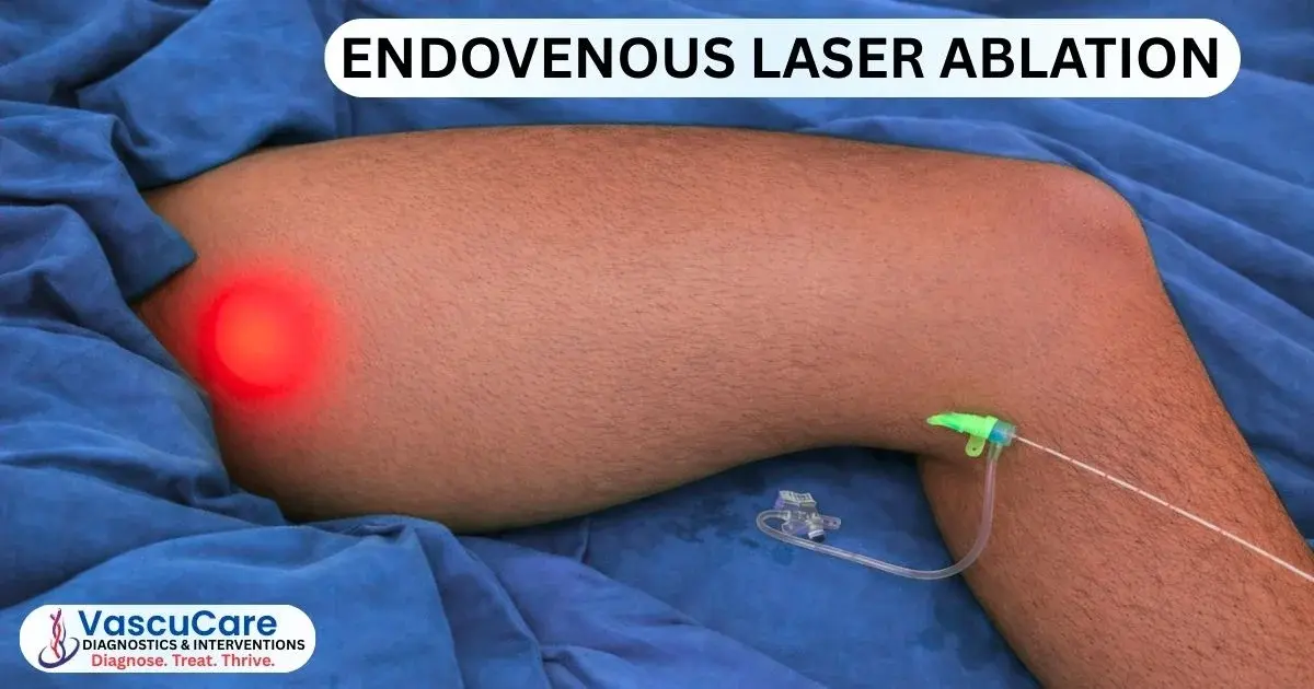 Endovenous Laser Ablation