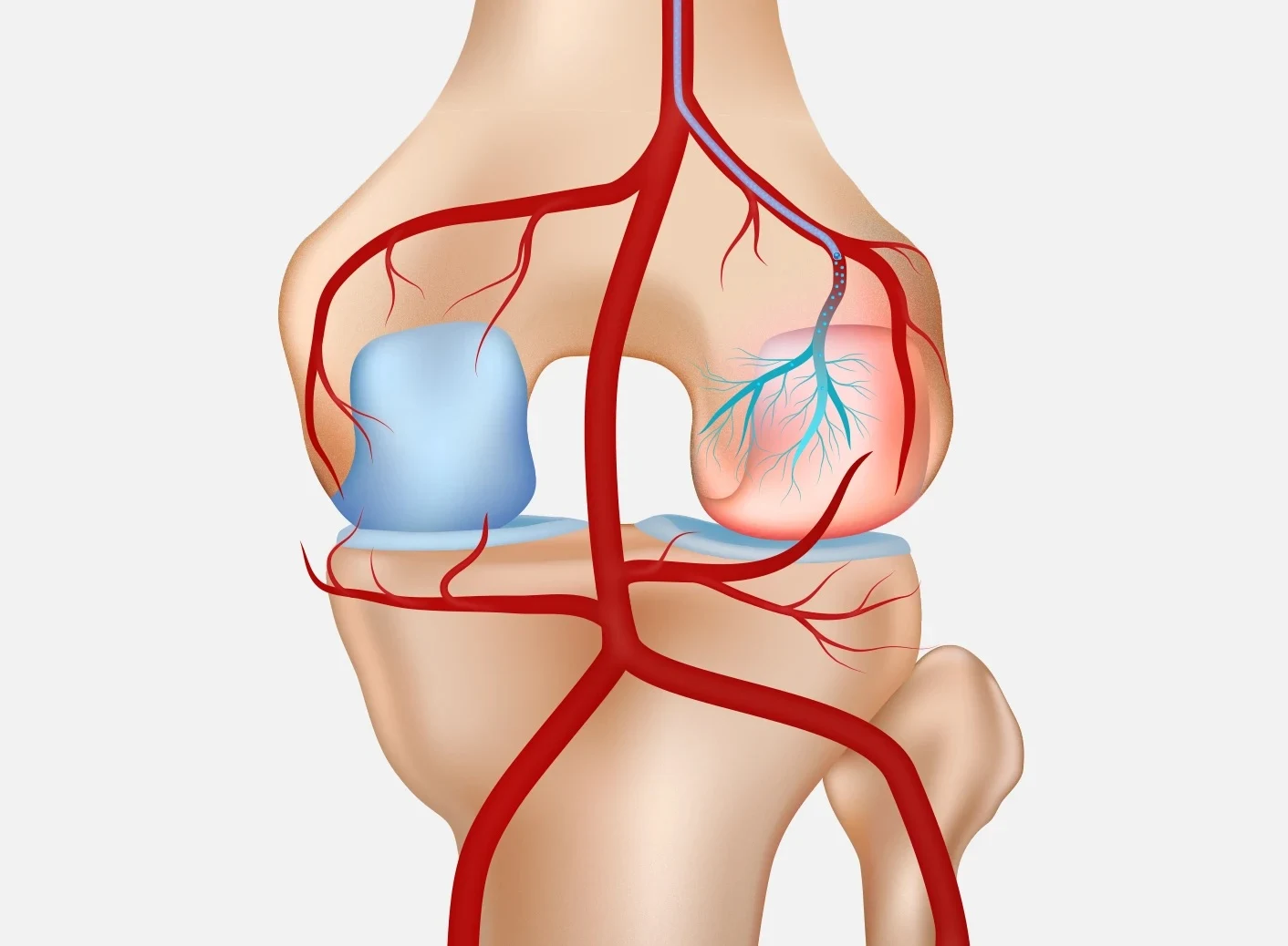 Genicular Artery Embolization (GAE)