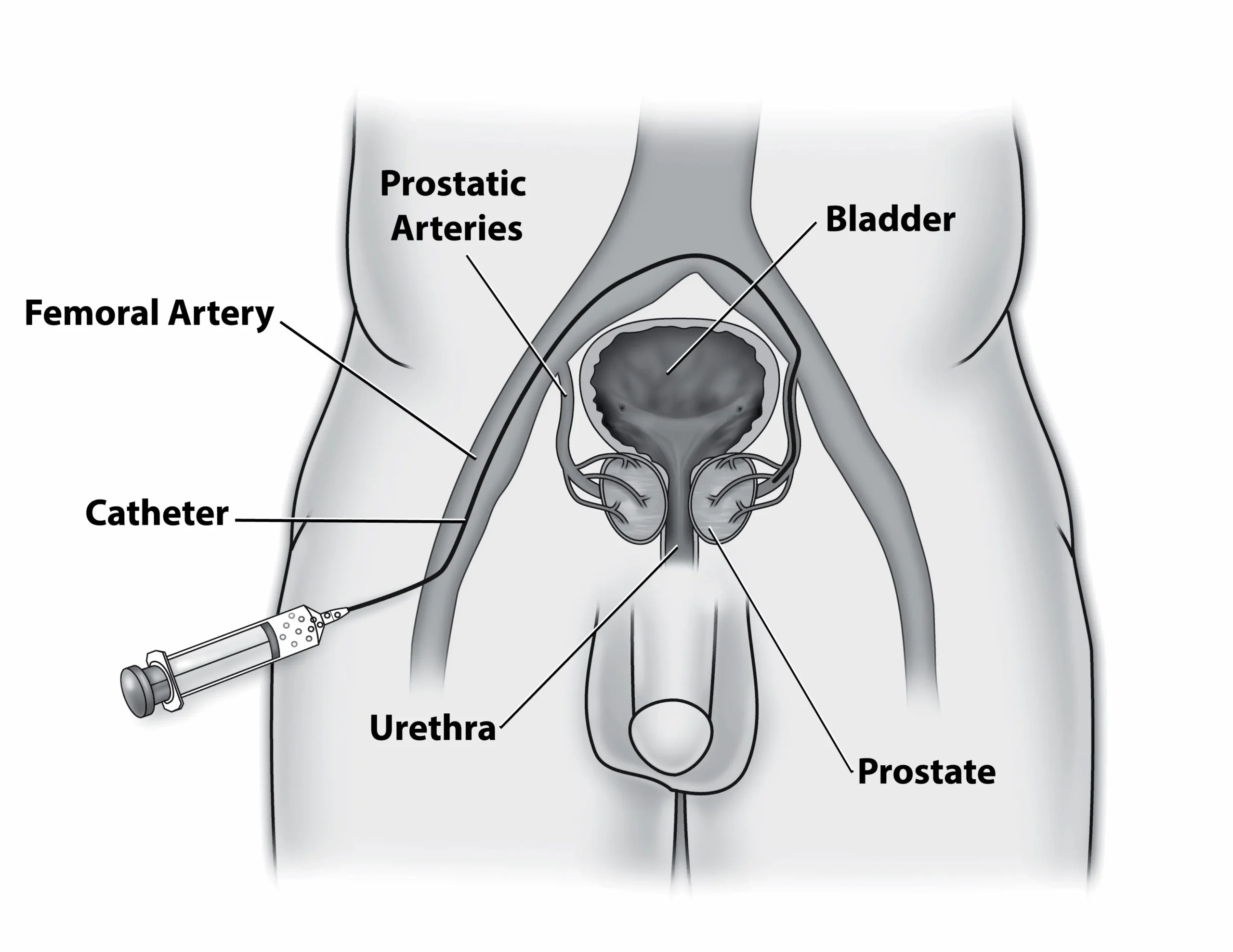 Prostate Artery Embolization (PAE)