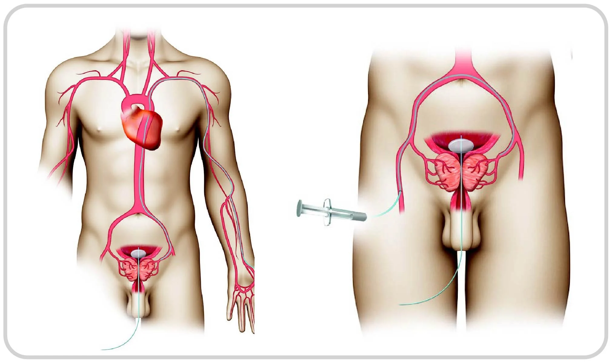 Prostate Artery Embolization (PAE)