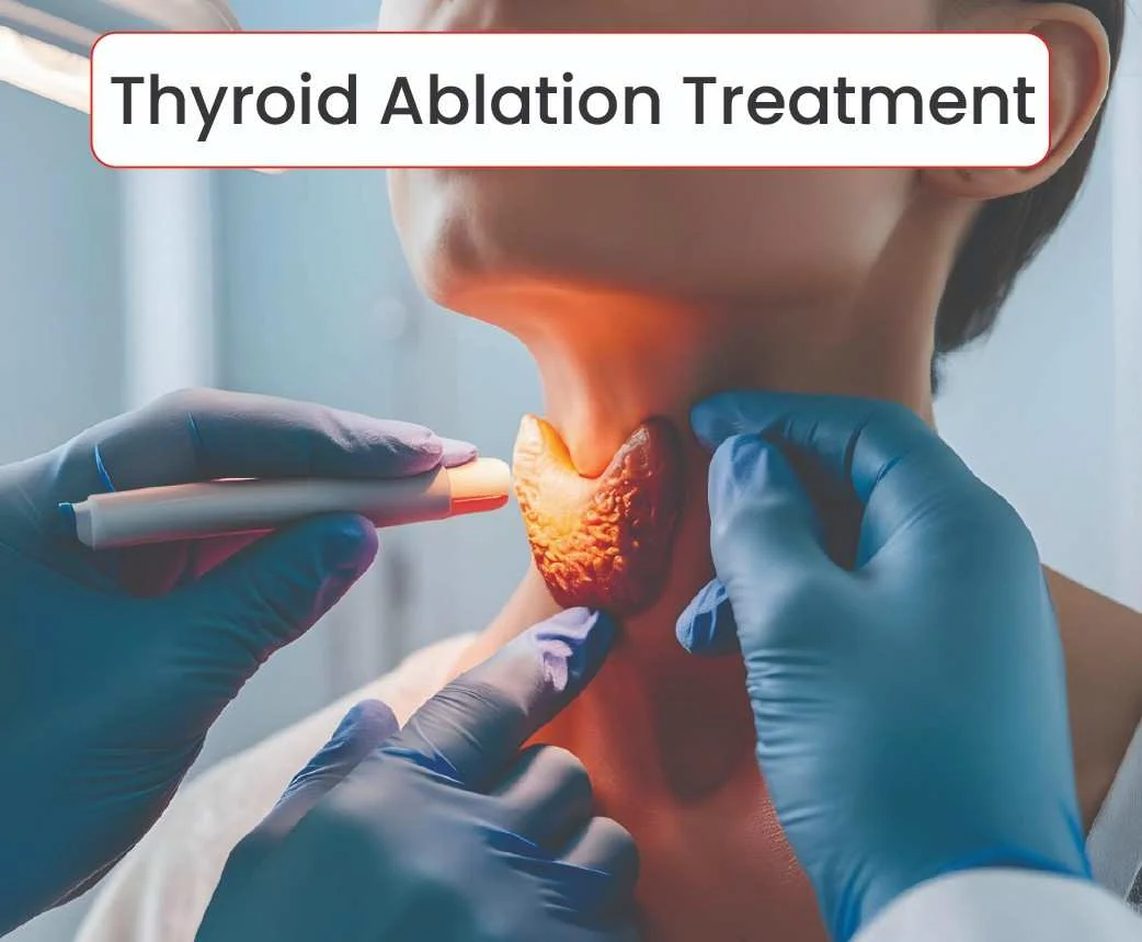 Thyroid Ablation Treatment