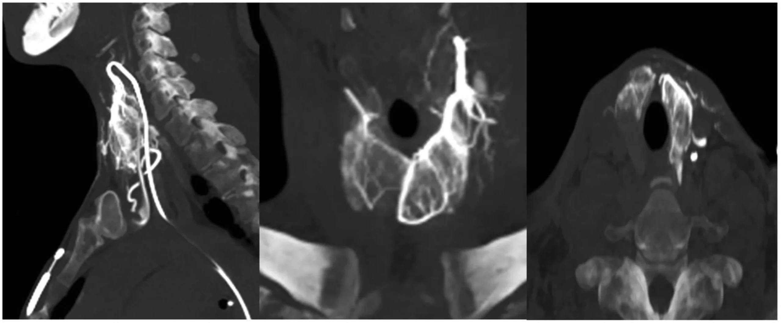 Thyroid Artery Embolization