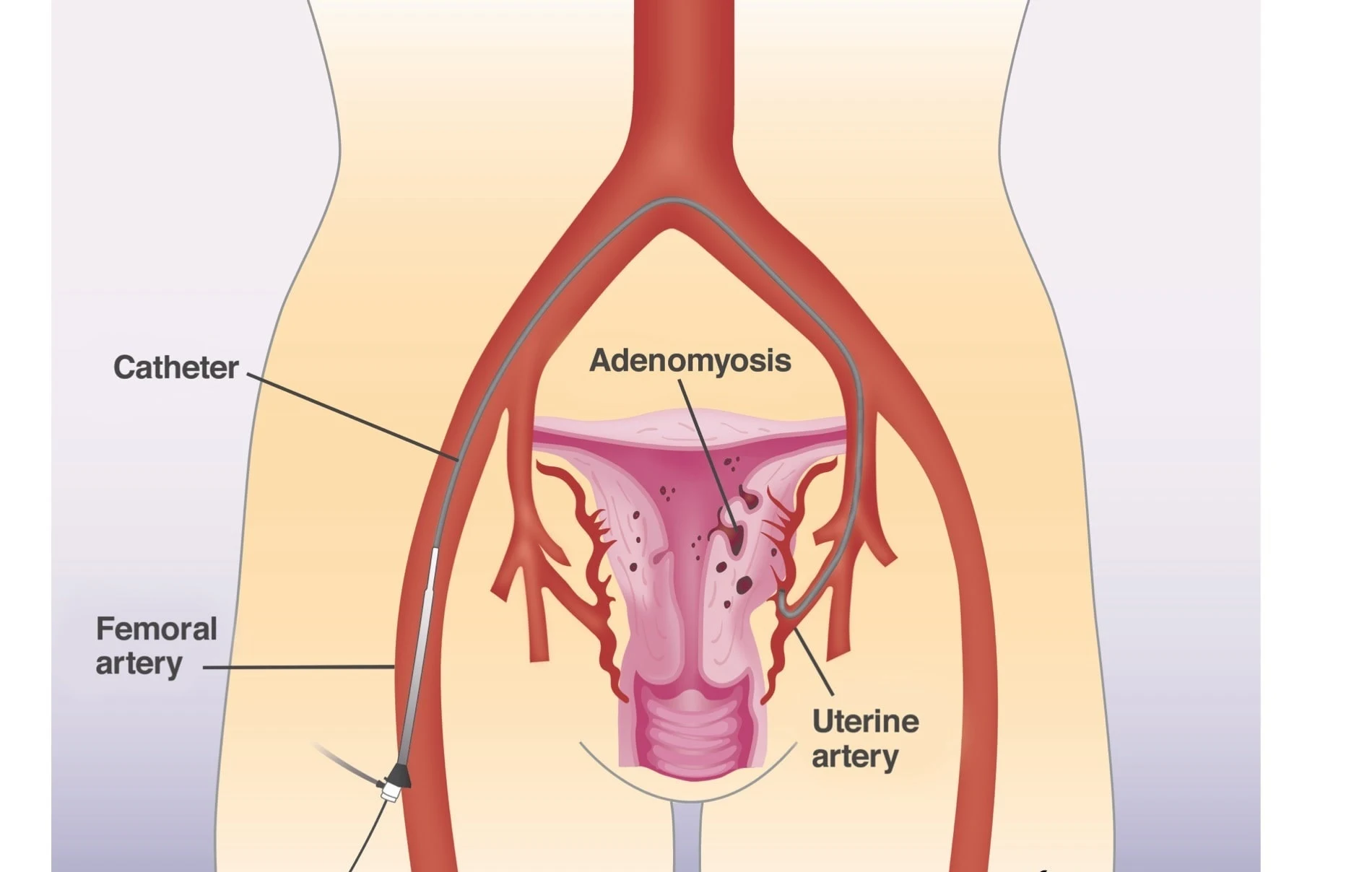 Uterine Artery Embolization (UAE)