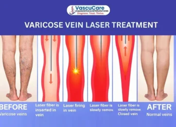 Varicose Vein L⁠aser T‌r‌ea‍tm⁠ent