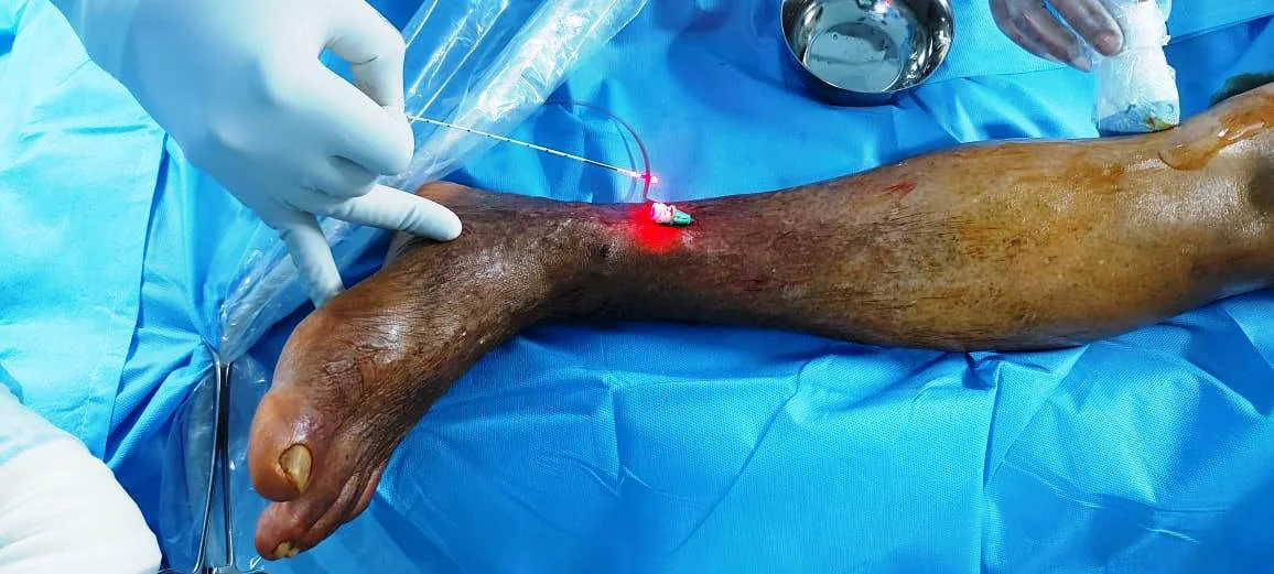 Varicose Vein Laser Treatment