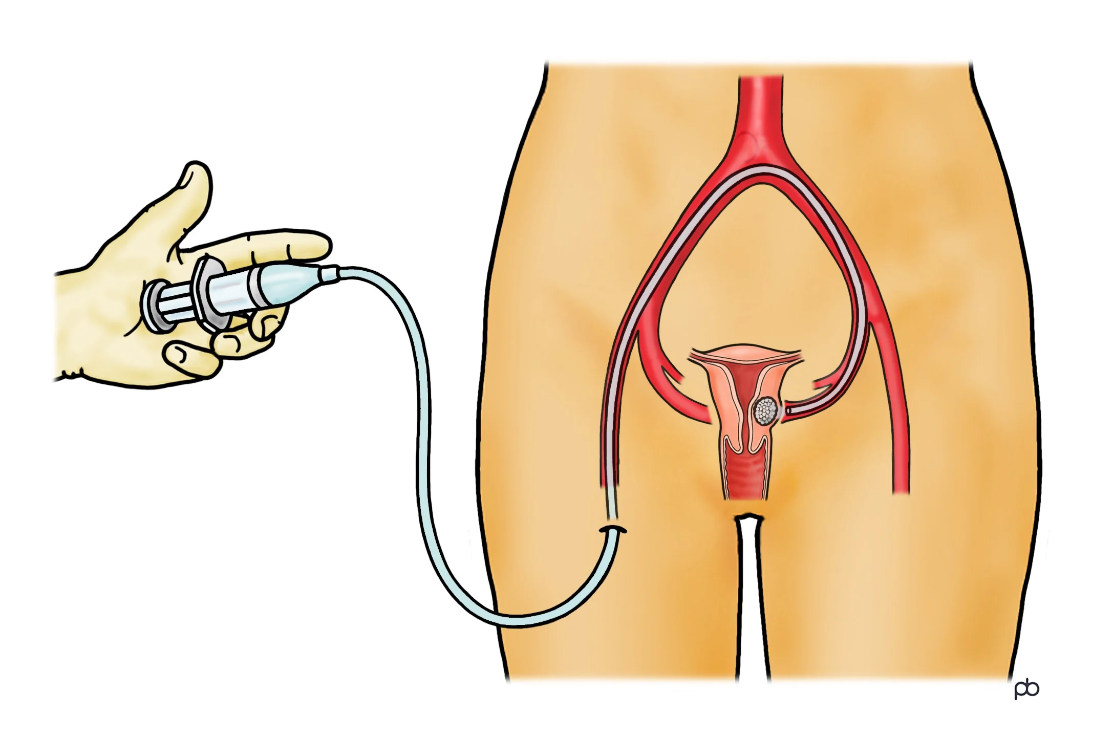 Uterine Artery Embolization(UAE)