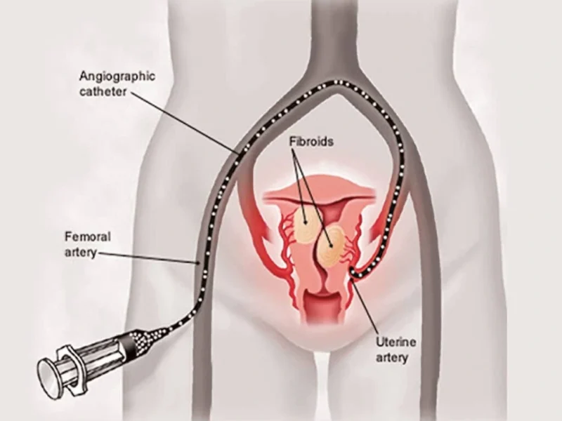 Uterine Fibroid Embolization (UFE)