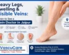 Heavy Legs Sw_elling & Visible Veins When to See a Vein Doctor in Jaipur_