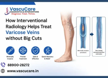 How Interventional Radiology Helps Treat Varicose Veins without Big Cuts