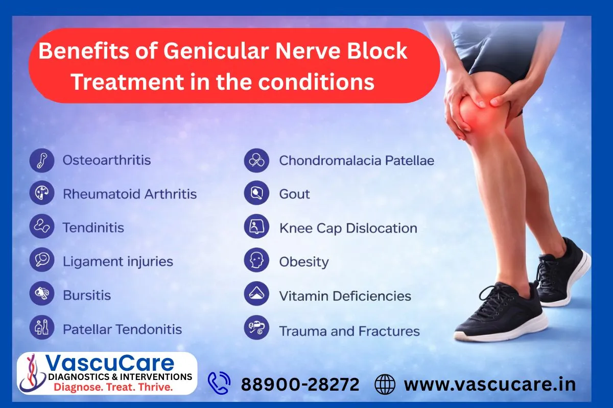 Benefits of Genicular Nerve Block Treatment for Arthritis Knee Pain.