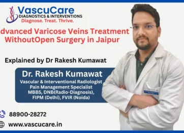 Advanced Varicose Veins Treatment Without Open Surgery in Jaipur