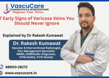 7 Early Signs of Varicose Veins You Should Never Ignore