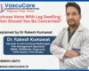 Varicose Veins With Leg Swelling When Should You Be Concerned 1